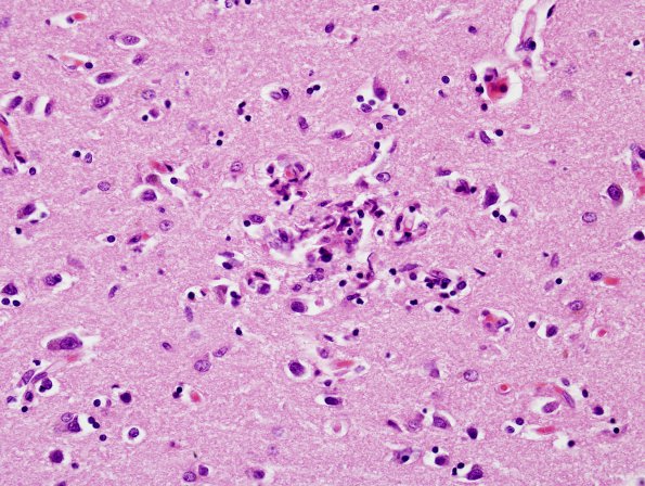 5A2 Encephalitis, West Nile (Case 5) H&E 8