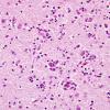 5A3 Encephalitis, West Nile (Case 5) H&E 3