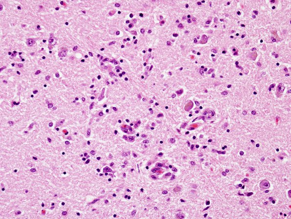 5A3 Encephalitis, West Nile (Case 5) H&E 3