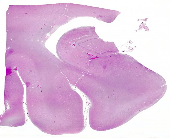 6A1 Meningoencephalitis, West Nile (Case 6)