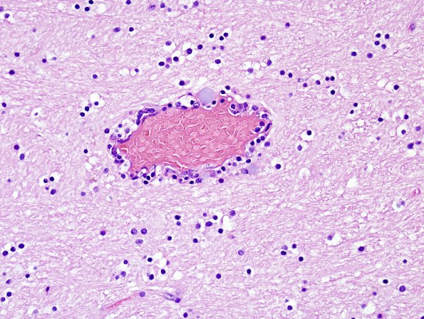 6A2 Meningoencephalitis, West Nile (Case 6) H&E 20