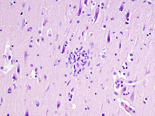 6A3 Meningoencephalitis, West Nile (Case 6) H&E 15