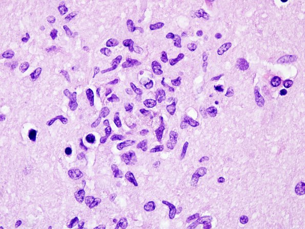 6A6 Meningoencephalitis, West Nile (Case 6) H&E 24