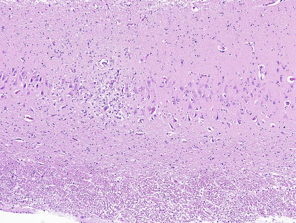 6B1 Meningoencephalitis, West Nile (Case 6) H&E 3