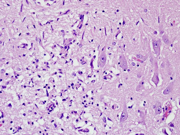 6B2 Meningoencephalitis, West Nile (Case 6) H&E 5