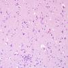 6C1 Meningoencephalitis, West Nile (Case 6) H&E 11