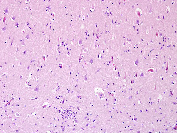 6C1 Meningoencephalitis, West Nile (Case 6) H&E 11