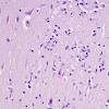 6C2 Meningoencephalitis, West Nile (Case 6) H&E 16