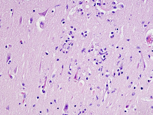 6C2 Meningoencephalitis, West Nile (Case 6) H&E 16