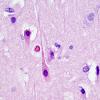 6C4 Meningoencephalitis, West Nile (Case 6) H&E 27