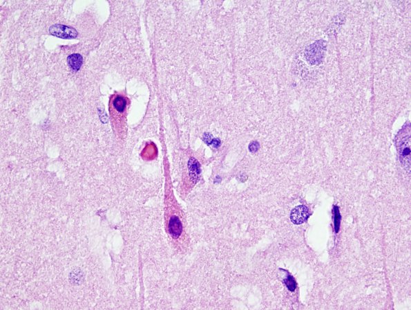 6C4 Meningoencephalitis, West Nile (Case 6) H&E 27