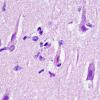 6C5 Meningoencephalitis, West Nile (Case 6) H&E 23