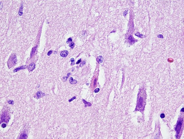 6C5 Meningoencephalitis, West Nile (Case 6) H&E 23