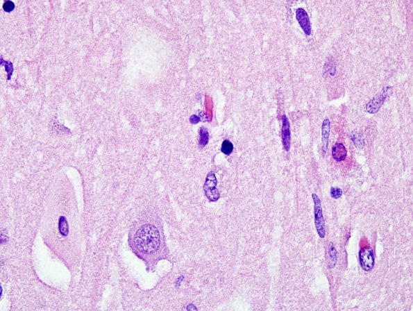 6C6 Meningoencephalitis, West Nile (Case 6) H&E 28