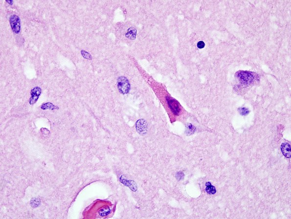 6C7 Meningoencephalitis, West Nile (Case 6) H&E 26