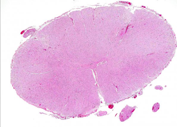 7A1 Myelitis, West Nile Virus (AANP 2003 Case 6) H&E whole mount