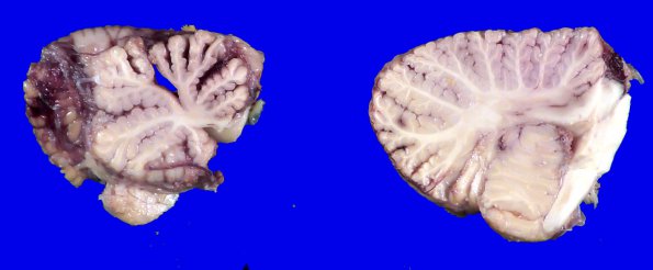 10A1 Wernicke Syndrome (Case 10) _4