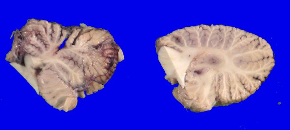 10A2 Wernicke Syndrome (Case 10) _5