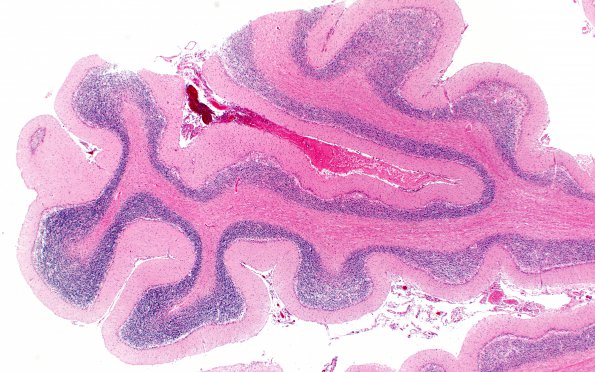 10B2 Wernicke syndrome (Case 10) N12 H&E 2X