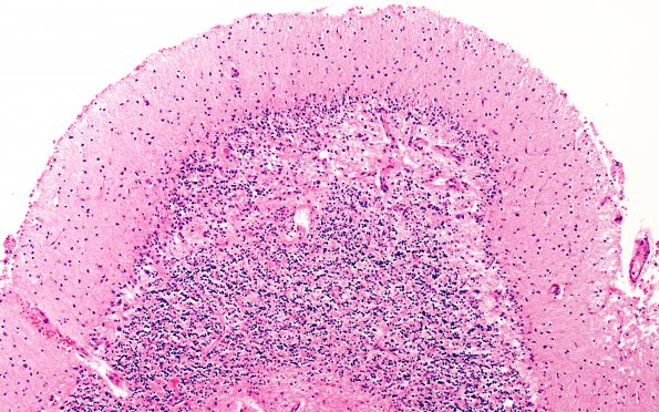 10B3 Wernicke syndrome (Case 10) N12 H&E 10X