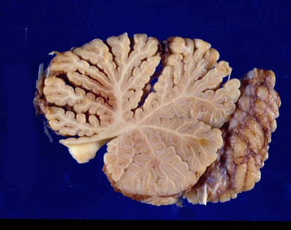 2 Atrophy, anterior superior vermis  (Case 2)