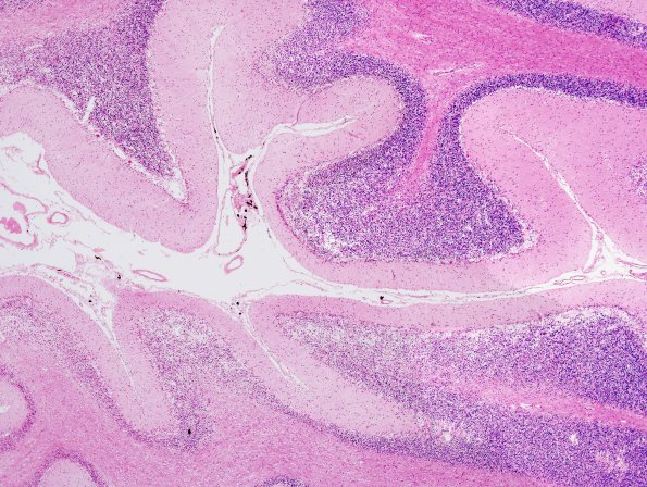 4A2 Atrophy, Cerebellum, (Alcoholic Degeneration, EtOH, VAH SLUH Case 4)H&E 1