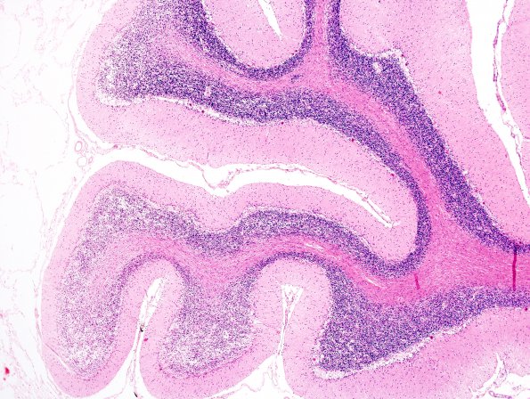 4A3 Atrophy, Cerebellum, (Alcoholic Degeneration, EtOH, VAH SLUH Case 4) H&E 2