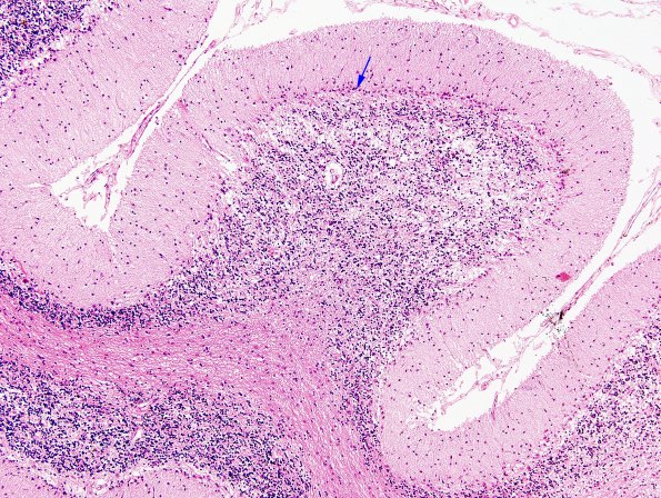 4A4 Atrophy, Cerebellum, (Alcoholic Degeneration, EtOH, VAH SLUH Case 4) H&E 3 copy