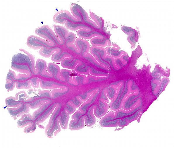 5A1 Alcoholic encephalopathy, Marchiafava-Bignami, no MB (Case 5) N17 vermis H&E copy