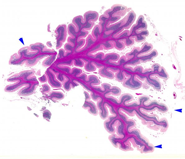 7A1 Atrophy, vermis, alcoholic (EtoH, Case 7) copy