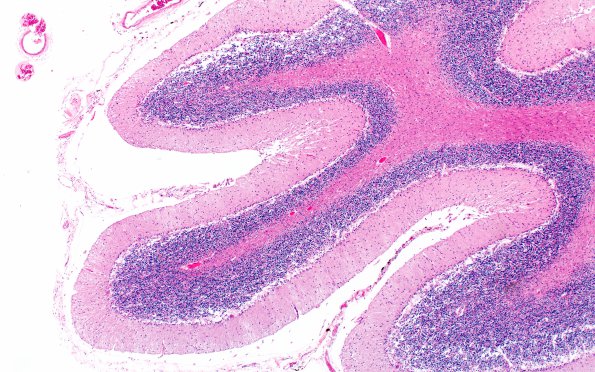 7A2 Atrophy, vermis, alcoholic (EtoH, Case 7) H&E 5