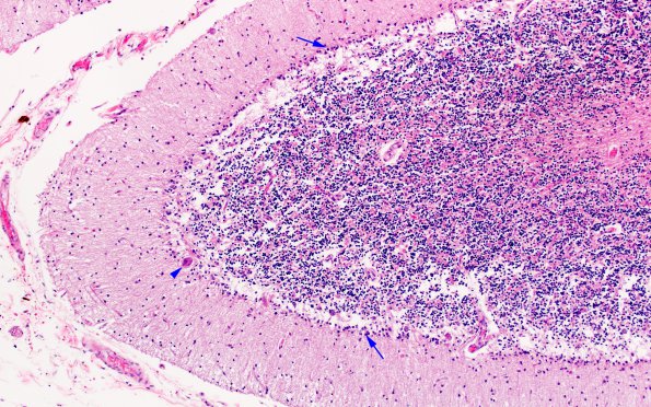 7A3 Atrophy, vermis, alcoholic (EtoH, Case 7) H&E 3 copy