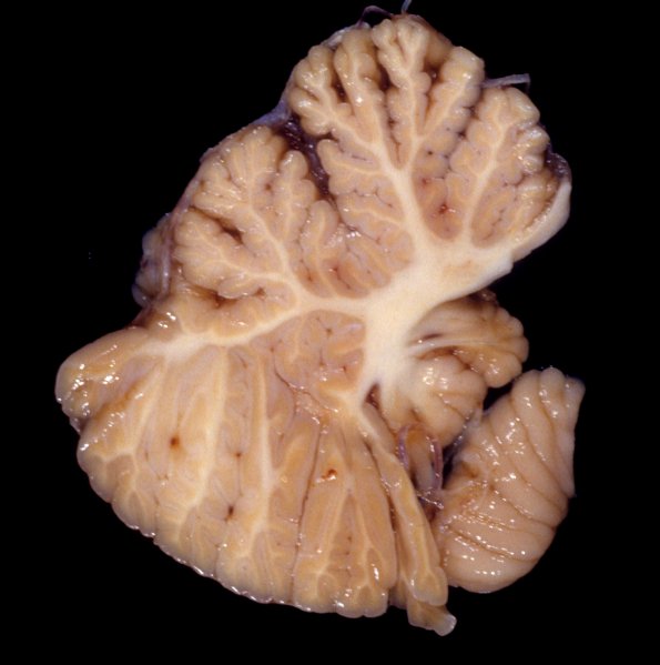 8A1 Atrophy, anterior superior vermis (Case 7)