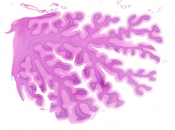 8B1 Atrophy, anterior superior vermis (Case 8) N12