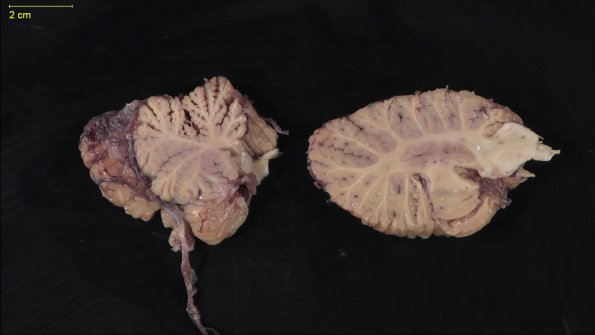 9A1 Atrophy, alcoholic, anterior superior vermis (Case 9)  _4