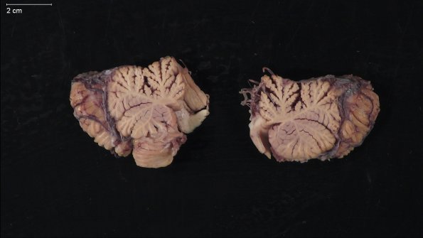 9A2 Atrophy, alcoholic, anterior superior vermis (Case 9)  _7