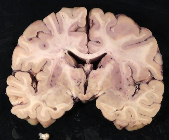 9A3 Atrophy, alcoholic, anterior superior vermis (Case 9)  _3A