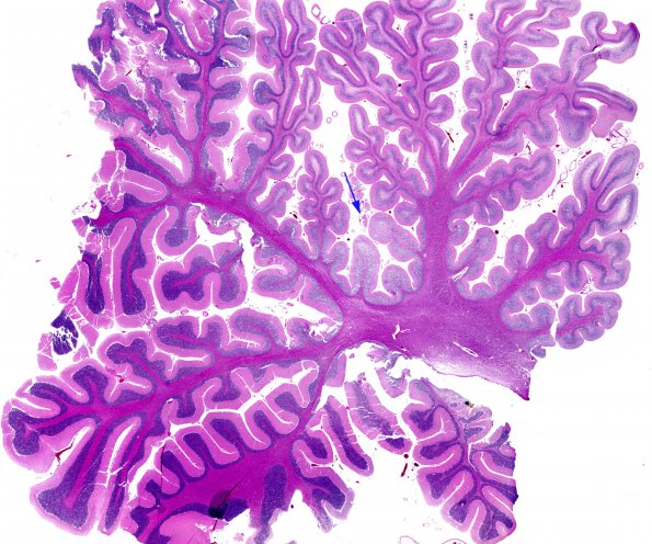 9B1 Atrophy, anterior superior vermis (Case 9) H&E whole mount copy