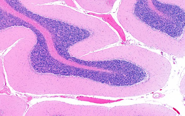 9B2 Atrophy, anterior superior vermis (Case 9) non-vermis control H&E 3