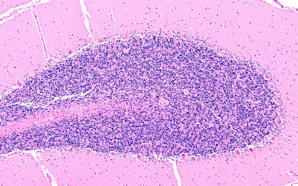 9B3 Atrophy, anterior superior vermis (Case 9) non-vermis control H&E 1