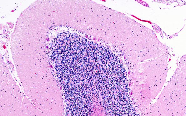 9B4 Atrophy, anterior superior vermis, non-atrophic vermis control (Case 9) H&E 2