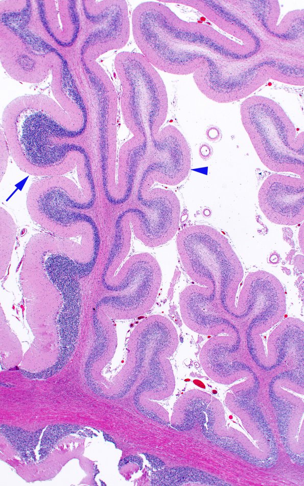 9B5 Atrophy, anterior superior vermis (Case 9) H&E 9 copy