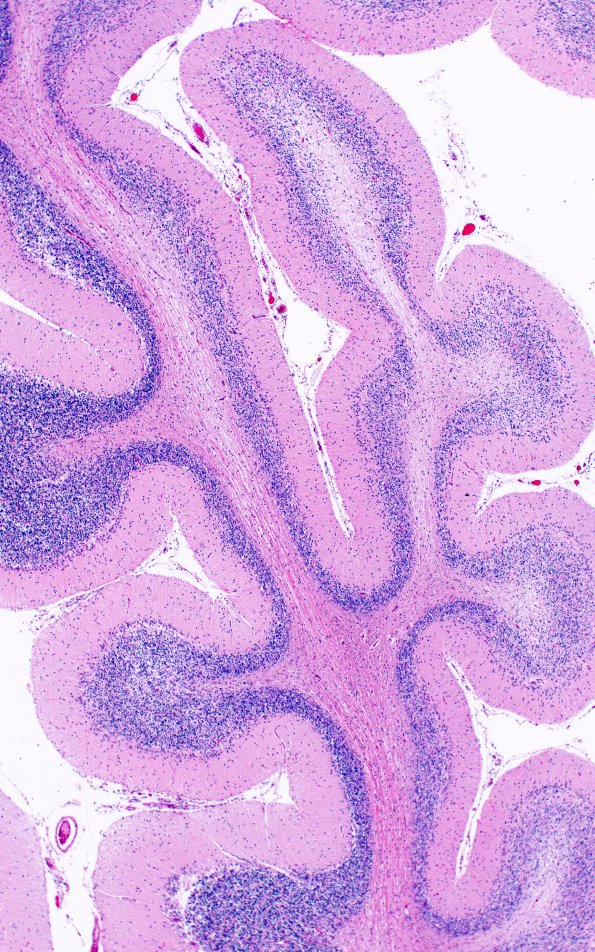 9B6 Atrophy, anterior superior vermis (Case 9) H&E 7