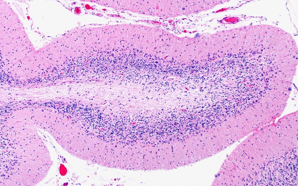 9B7 Atrophy, anterior superior vermis (Case 9) H&E 6