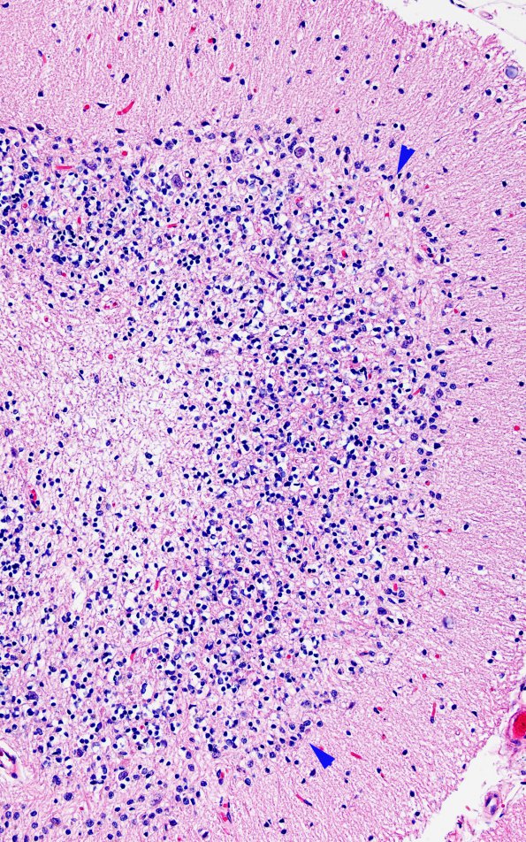 9B8 Atrophy, anterior superior vermis (Case 9) H&E 5 copy