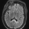 1A1 Alcoholic Encephalopathy - Marchiafava-Bignami (Case 1) Flair 1 copy - Copy