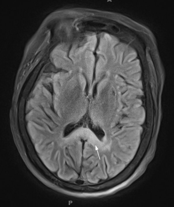 1A1 Alcoholic Encephalopathy - Marchiafava-Bignami (Case 1) Flair 1 copy - Copy