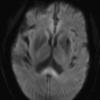 1A2 Marchiafava-Bignami (Case 1) Diffusion Trace 1 - Copy