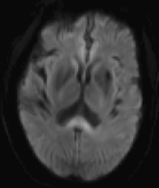 1A2 Marchiafava-Bignami (Case 1) Diffusion Trace 1 - Copy