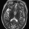 1A3 Alcoholic Encephalopathy - Marchiafava-Bignami (Case 1) T2 W1 - Copy